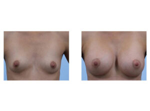 Before & After Breast Surgery
