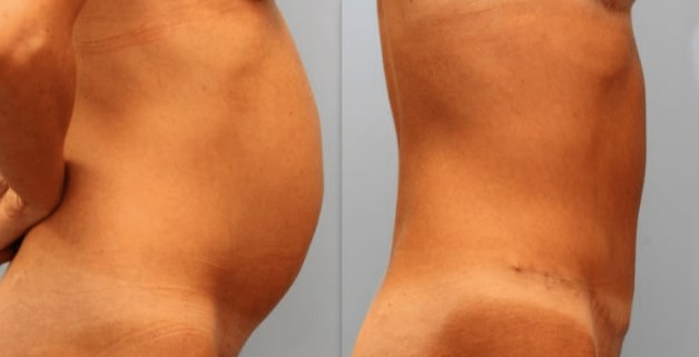 Photo 2: Tummy Tuck repairing very loose connective tissue in an otherwise thin woman. Patient shown 3 months post-op. Additional scar fading occurs over first year.