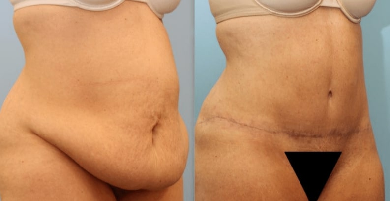 Photo 3: Liposuction combined with tummy tuck to reduce extra fat and skin. Patient shown 3 months post-op. Additional scar fading occurs over first year.