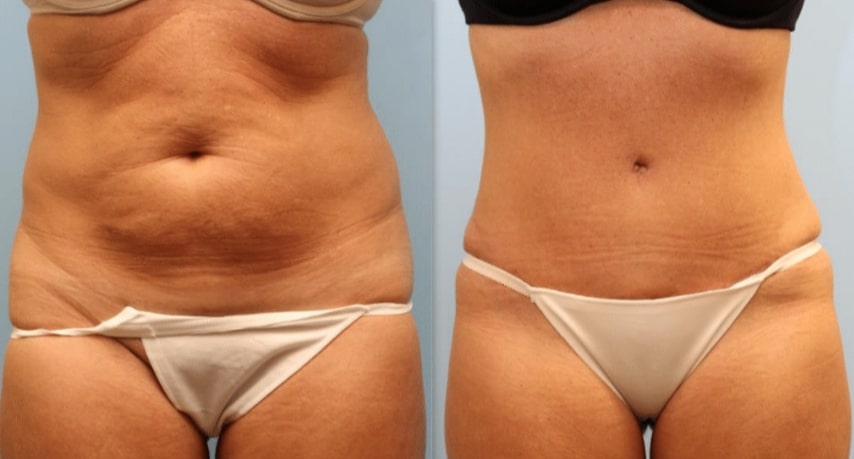Photo 5: 360 Lipo and tummy tuck to aggressively reshape abdomen and waist. Note how scars easily hidden by bikini bottom or underwear.