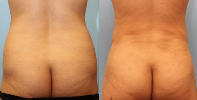 Photo 8: Liposuction used to improve hourglass shape and lower waistline